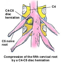 spinal stenosis spinal stenosis